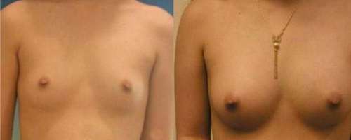 Is een borstvergroting van kleine strakke borsten met lipofilling mogelijk?