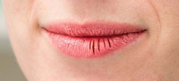 Dokter Don Wat Kan Ik Doen Aan Gebarsten Lippen