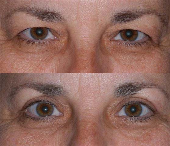 ooglidcorrectie vergoeding