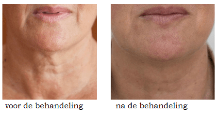 Profhilo behandeling voor en na